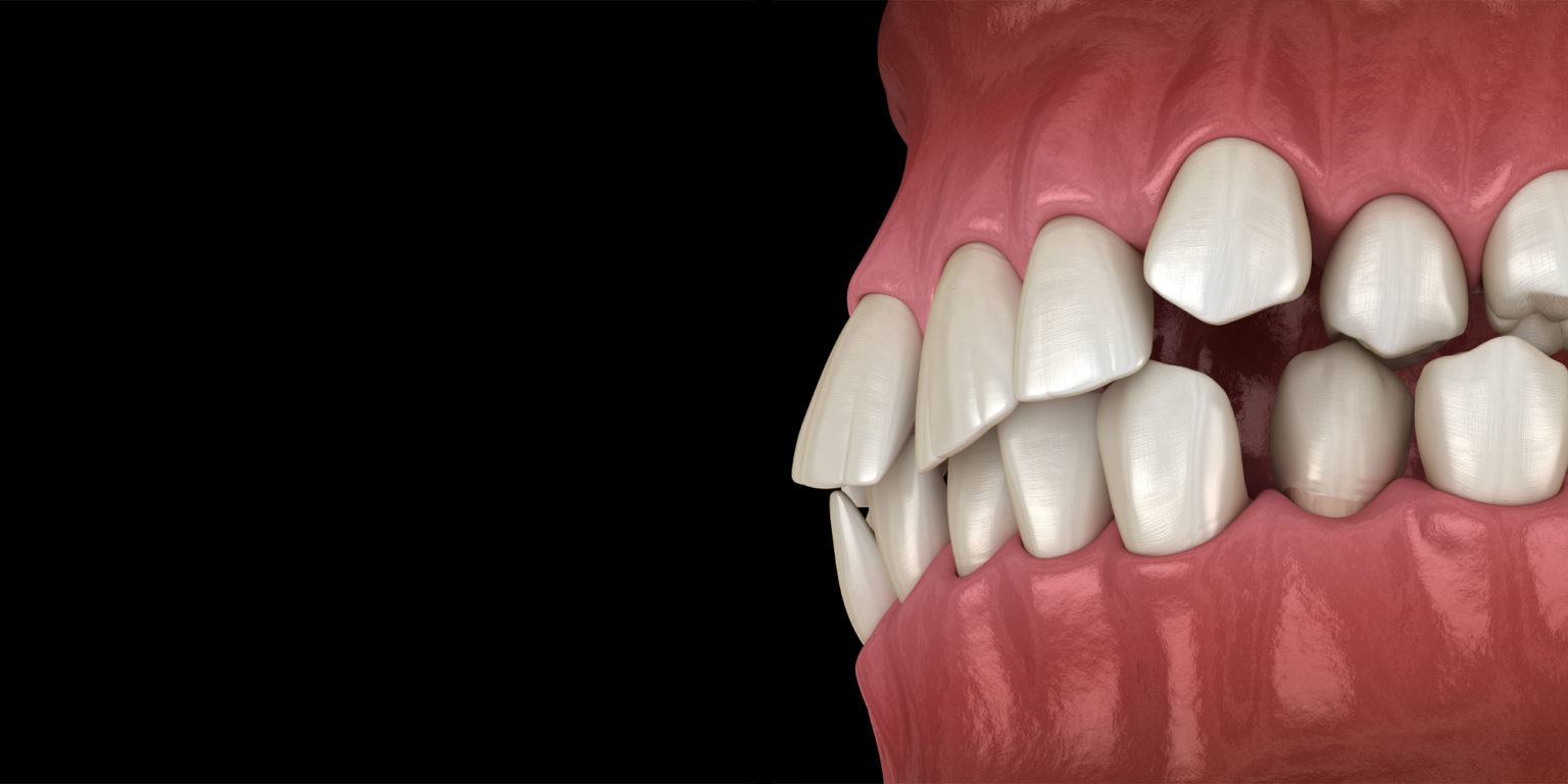 Crooked Teeth | Atlanta, GA | Artistic Dentistry of Atlanta